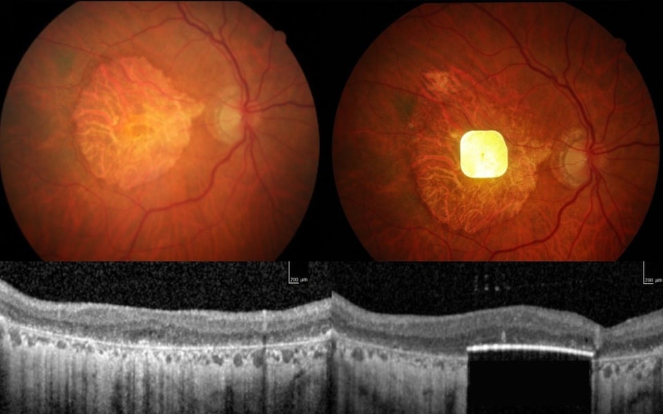 Chip Prima cấy vào mắt trái